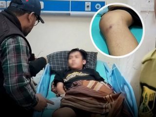 Menolak Dimintai Uang, Siswa SMP di Sukabumi Dianiaya Kakak Kelas Hingga Patah Tulang dan Terancam Lumpuh